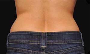 Coolsculpting Flank Before and After | Little Lipo