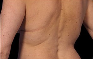 Coolsculpting Flank Before and After | Little Lipo