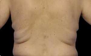 Coolsculpting Flank Before and After | Little Lipo