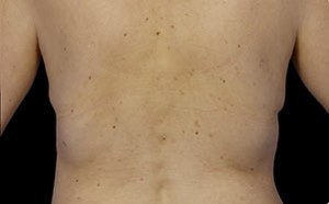 Coolsculpting Flank Before and After | Little Lipo