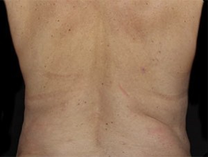 Coolsculpting Flank Before and After | Little Lipo