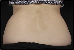 Coolsculpting Flank Before and After | Little Lipo