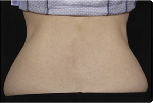 Coolsculpting Flank Before and After | Little Lipo