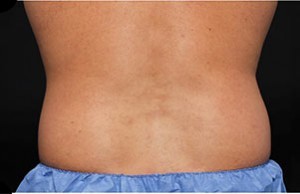 Coolsculpting Flank Before and After | Little Lipo