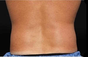 Coolsculpting Flank Before and After | Little Lipo