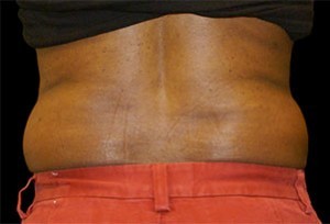 Coolsculpting Flank Before and After | Little Lipo