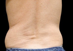 Coolsculpting Flank Before and After | Little Lipo