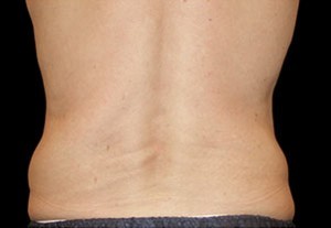 Coolsculpting Flank Before and After | Little Lipo