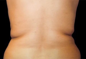 Coolsculpting Flank Before and After | Little Lipo