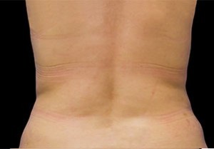 Coolsculpting Flank Before and After | Little Lipo