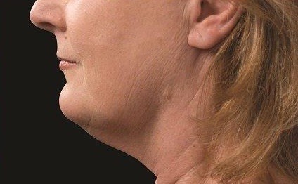 Coolsculpting Neck Before and After | Little Lipo