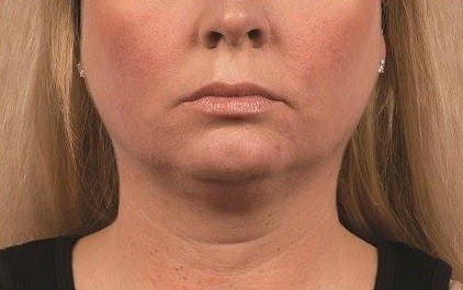 Coolsculpting Neck Before and After | Little Lipo