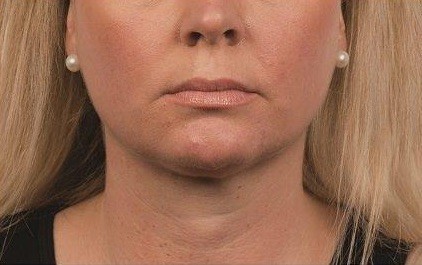 Coolsculpting Neck Before and After | Little Lipo