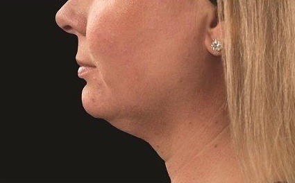 Coolsculpting Neck Before and After | Little Lipo