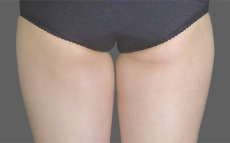 Coolsculpting Thighs Before and After | Little Lipo