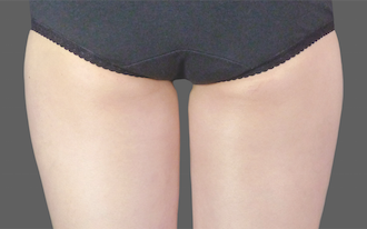 Coolsculpting Thighs Before and After | Little Lipo