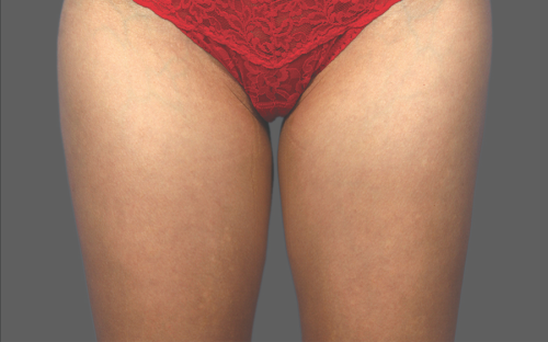 Coolsculpting Thighs Before and After | Little Lipo