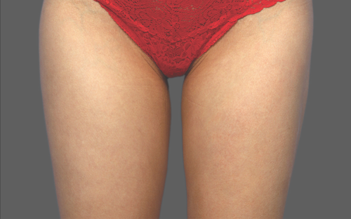 Coolsculpting Thighs Before and After | Little Lipo