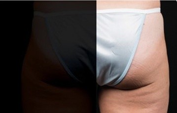 Coolsculpting Thighs Before and After | Little Lipo