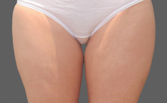 Coolsculpting Thighs Before and After | Little Lipo