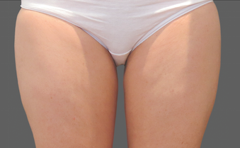 Coolsculpting Thighs Before and After | Little Lipo