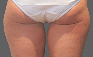 Coolsculpting Thighs Before and After | Little Lipo
