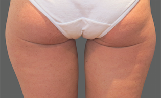 Coolsculpting Thighs Before and After | Little Lipo