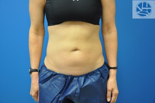 Coolsculpting Before and After | Little Lipo