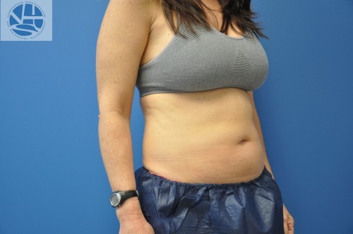 Coolsculpting Before and After | Little Lipo