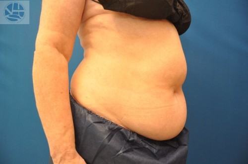 Coolsculpting Before and After | Little Lipo