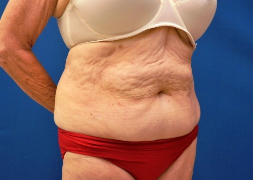 Coolsculpting Before and After | Little Lipo