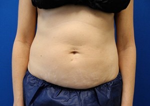 Coolsculpting Before and After | Little Lipo