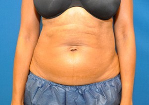 Coolsculpting Before and After | Little Lipo