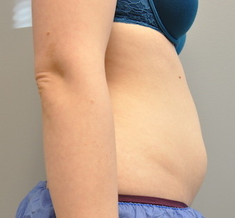 Coolsculpting Before and After | Little Lipo