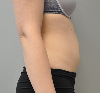 Coolsculpting Before and After | Little Lipo