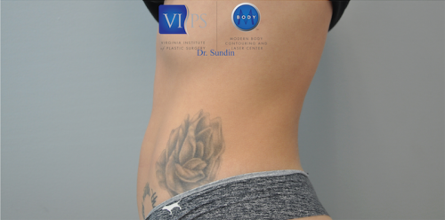 Coolsculpting Before and After | Little Lipo