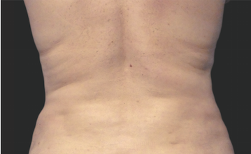 Coolsculpting Before and After | Little Lipo