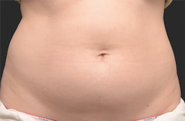 Coolsculpting Before and After | Little Lipo