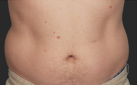 Coolsculpting Before and After | Little Lipo