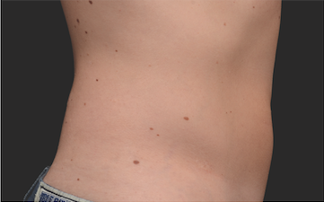 Coolsculpting Before and After | Little Lipo