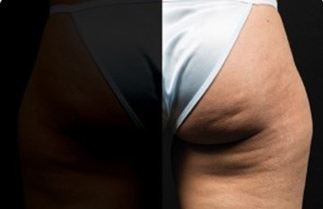 Coolsculpting Before and After | Little Lipo