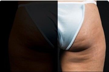 Coolsculpting Before and After | Little Lipo