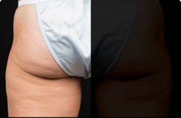 Coolsculpting Before and After | Little Lipo