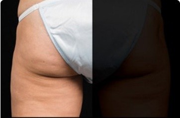 Coolsculpting Before and After | Little Lipo