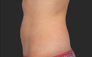 Coolsculpting Before and After | Little Lipo