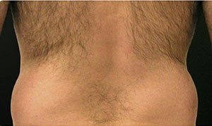 Coolsculpting Before and After | Little Lipo