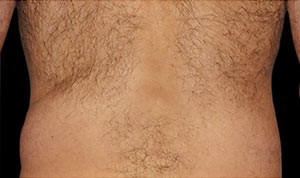 Coolsculpting Before and After | Little Lipo