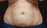 Coolsculpting Before and After | Little Lipo