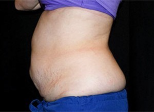 Coolsculpting Before and After | Little Lipo