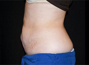 Coolsculpting Before and After | Little Lipo